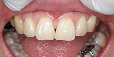すきっ歯症例3after