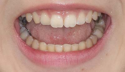 幼い歯の治療前１